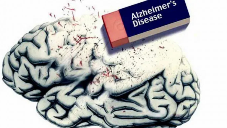 alzheimers disease
